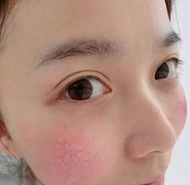 皮膚容易過(guò)敏的處理方法