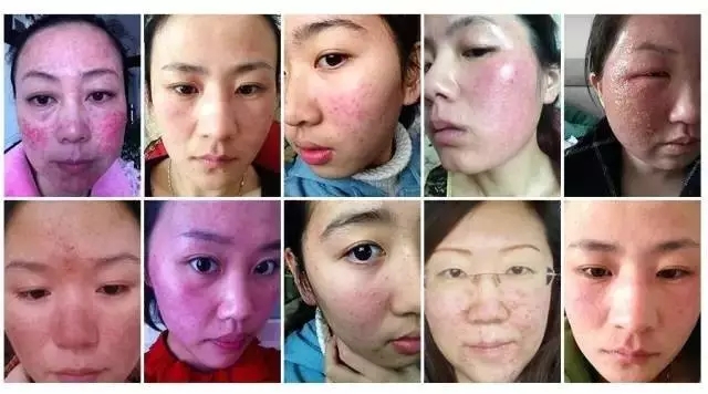 如何判斷自己的皮膚是不是激素臉？