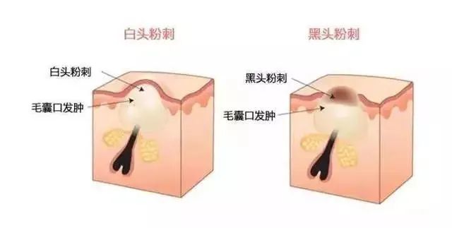 如何有效改善閉口粉刺？改善閉口粉刺的方法！