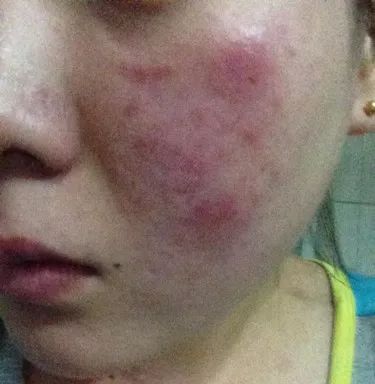 紅血絲的種類有哪些？