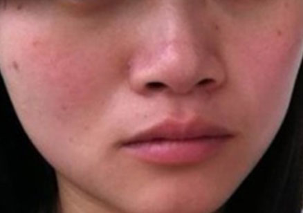 如何判斷自己是不是敏感性皮膚？